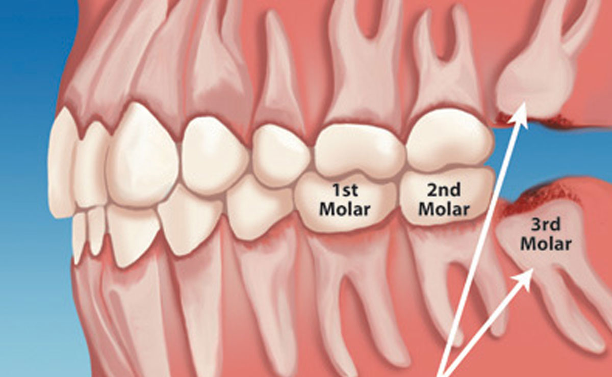 Estrazione denti inclusi